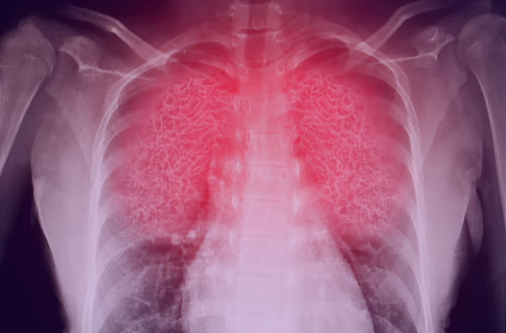 64de259a2baa36880e7bb669_Lung-Inflammation2